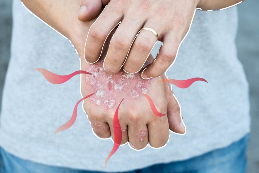 Atopic Dermatitis Eczema – Understanding the Most Common Form of Chronic Skin Inflammation