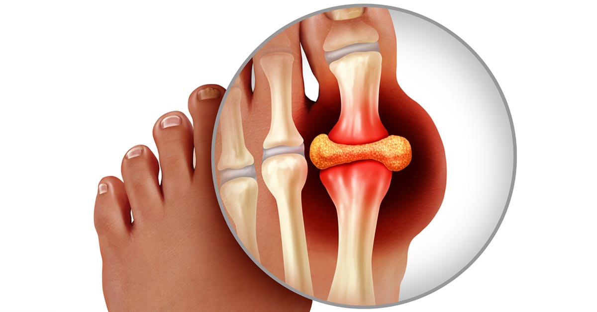 Gout Arthritis Medications: Understanding Treatment Options, Including Rinvoq's Role