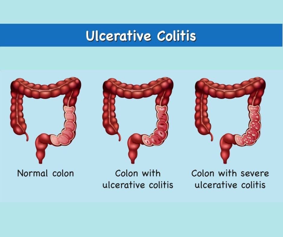 Ozanimod (Zeposia) for Ulcerative Colitis: A Modern Oral Therapy in the USA